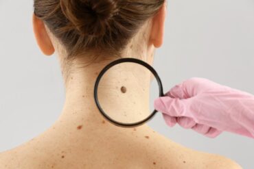 prevenzione tumori della pelle